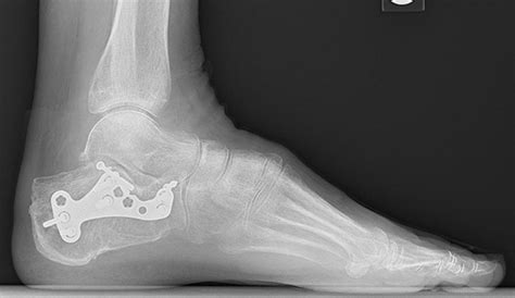 Film Ankle Xray Radiograph Showing Heel Bone Broken With Plate And