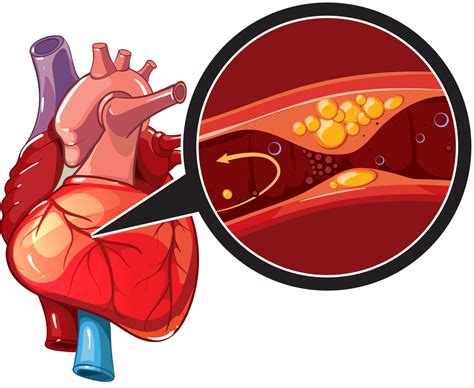 Coronary Artery Disease Treatment Causes And Prevention