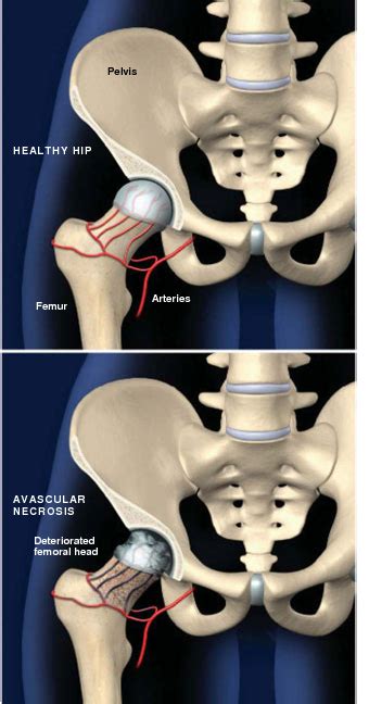 Avascular Necrosis AVN Of The Hip Orthopedic Specialist Prescott Az