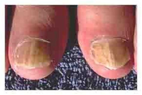 No Simple Solution For Toenail Infections Organic Authority