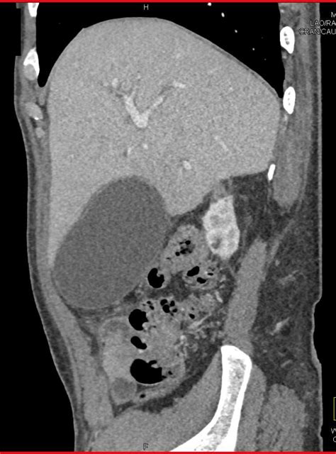 Pediatric Pictures Avascular Necrosis With Ct Crescent Sign For Avn