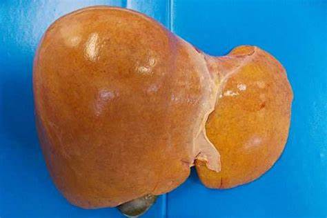 Жировой гепатоз симптомы лечение диета Как лечить жировой гепатоз – симптомы и лечение гепатоза, диета Как лечить жировой гепатоз – симптомы и лечение гепатоза, диета Жировой гепатоз симптомы лечение диета