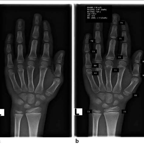 Radiograph Of The Left Hand And Wrist Before A And After B