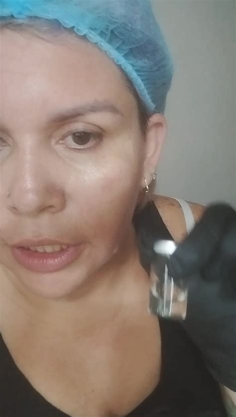 Qué Es Y Para Qué Sirve El Microneedling El Microneedling Es Un Tratamiento Para Todas Aquellas