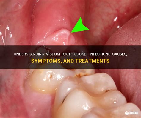 Understanding Wisdom Tooth Socket Infections Causes Symptoms And