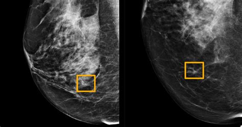 Ai Is Learning To Read Mammograms The New York Times