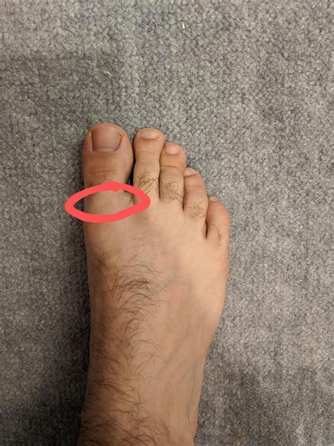 Right Big Toe Joint Pain Footfunction