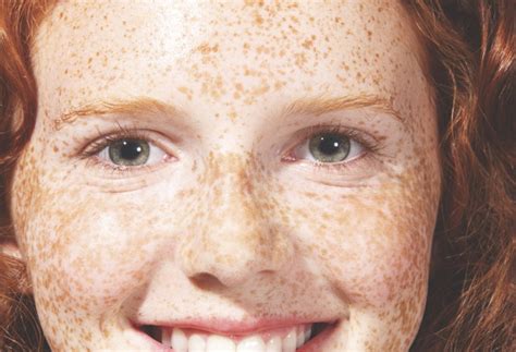What Are Freckles How It Works