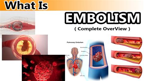 What Is Embolism Clear And Complete Overview Youtube