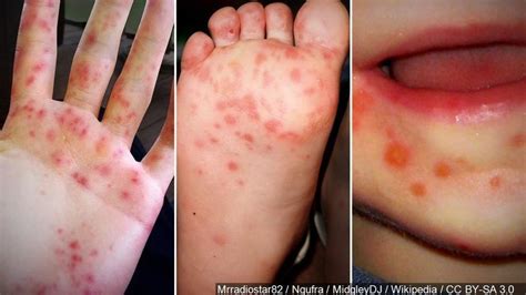 Hand Foot And Mouth Disease Outbreak Hits Johns Hopkins WBFF