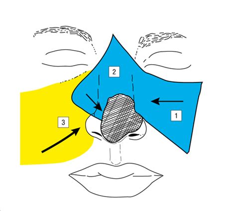 Triple Flap Technique For Reconstruction Of Large Nasal Defects Jama