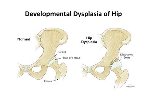 Developmental Dysplasia Hip