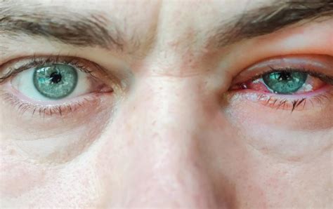Chlamydia Eye Infection Causes Symptoms Treatment Obn