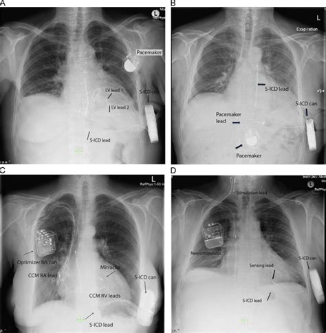 Subcutaneous Implantable Cardioverter Defibrillator First Single