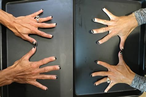 Hand Rejuvenation Evansville Best Radiesse Treatments In Evansville