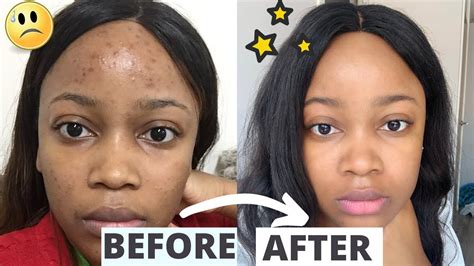 How I Got Rid Of Acne Dark Spots For Good My Skincare Routine Youtube