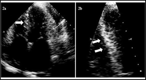 Echocardiography In A 57 Year Old Man With Systemic Amyloidosis