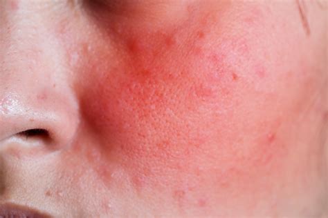 Common Skin Conditions That Cause Facial Redness Fldscc