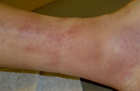 Superficial Phlebitis Pictures 15 Photos Images Illnessee