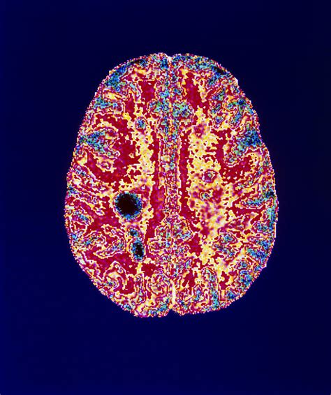 Col Mri Scan Of A Brain With Multiple Sclerosis Photograph By
