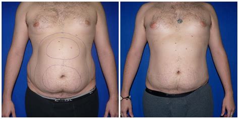 Patient 276 Male Liposuction Before And After Photos Katy Plastic