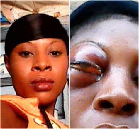 Lady Wakes Up With Extremely Swollen Eye After She Reportedly Dreamt