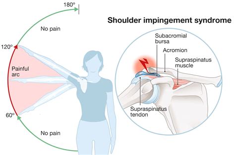 Signs Of Shoulder Impingement Syndrome Sexiezpicz Web Porn