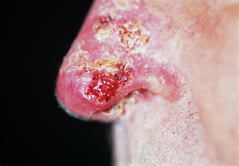 Skin Cancer On Nose Photograph By Dr P Marazziscience