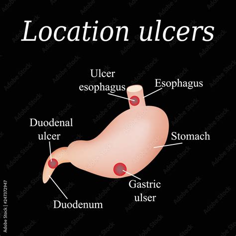 Esophagus Ulcer Affected Ulcer Of Esophagus Vector Illustration On My