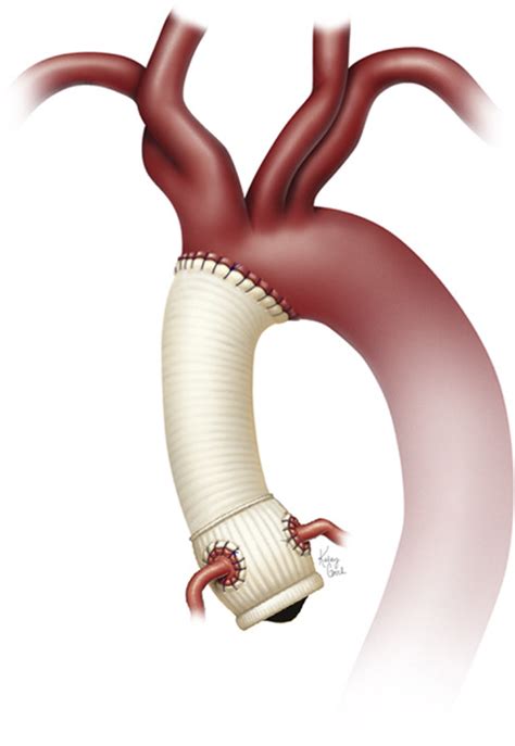 Elective Primary Aortic Root Replacement With And Without Hemiarch