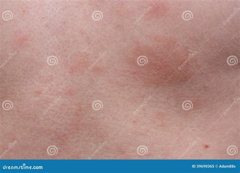 Allergie Dermatologique De Peau Dexemple Image Stock Image Du Cancer