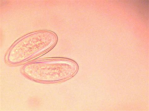 Enterobius Vermicularis Pinworms Eggs Can Be Identified By One