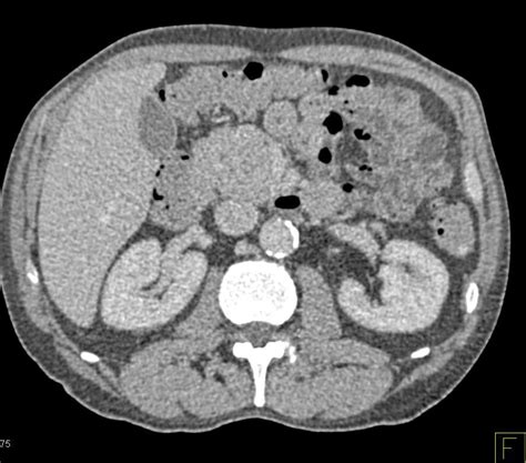 Carcinoma Of The Head Of The Pancreas Pancreas Case Studies Ctisus