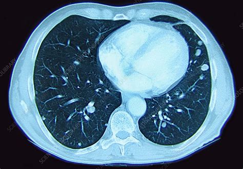 Lung Metastases Stock Image C0270968 Science Photo Library