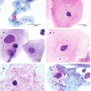 Papanicolaou smear (pap smear, cervical smear) is a safe, noninvasive cytological examination for early detection of cervical cancer. a) Overview of a Pap smear with minimal cytological ...