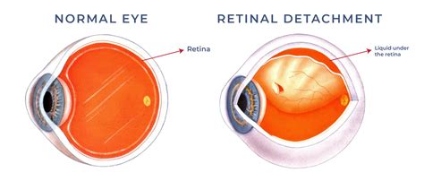 Symptoms Of A Retinal Detachment Front Range Retina