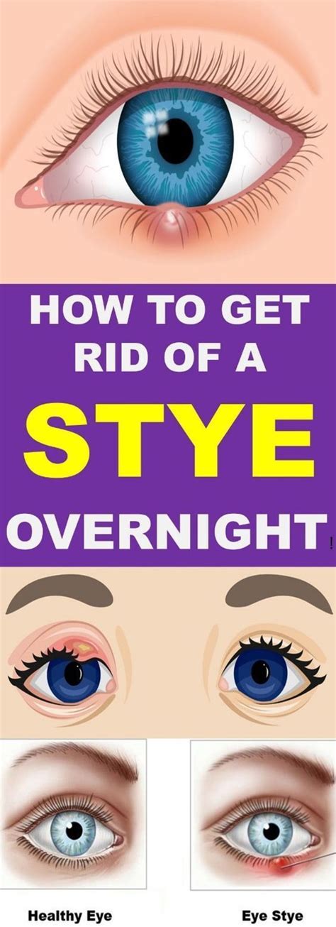 How To Get Rid Of A Stye Overnight Kok Vannak Stye Eye Stye