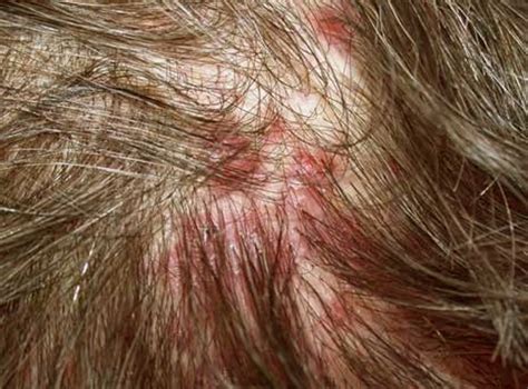 👉 Itchy Bumps On Scalp Treatment Pictures Symptoms Causes