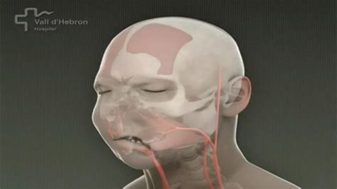 Doctors Videos Backup Worlds First Full Face Transplant Carried Out