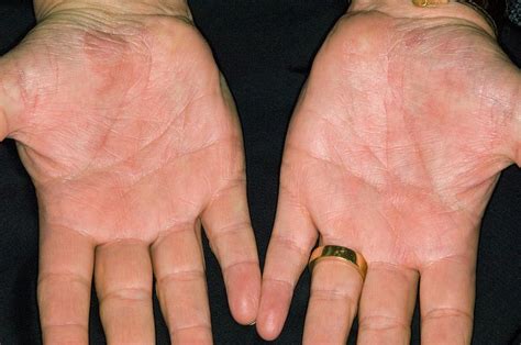 Images Of Psoriasis On The Hands