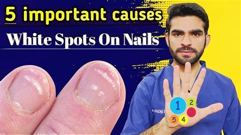 Leukonychia Causes 5 Important Causes Of White Spots On Nails Youtube