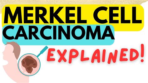 Merkel Cell Carcinoma Cause Symptoms Risk Factors Diagnosis And