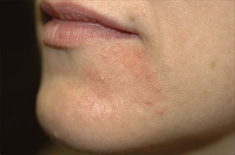 Perioral Dermatitis Associated With An Inhaled Corticosteroid