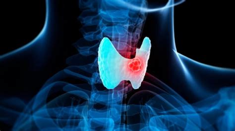 8 Things To Know About Thyroid Cancer