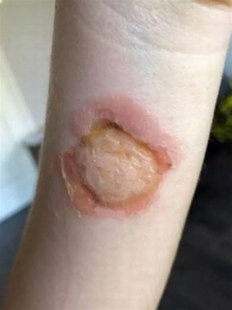 Spider Bite Leaves Girl Hospitalised As Seven Year Olds Skin Eaten