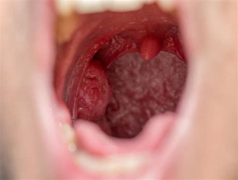 Signs Of Strep Throat Facty Health