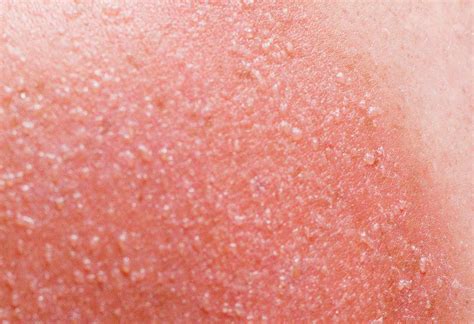 What Is Sun Poisoning — And How To Stop It From Happening