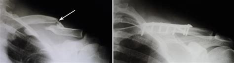 Clavical Fracture Broken Collarbone Dr Mukhis Raj Hospital
