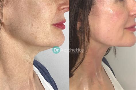 Botox For Jowls Non Surgical Jowl Lift Dr Aesthetica