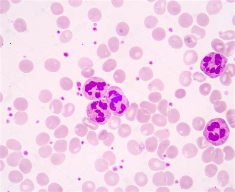 White Blood Cells In Blood Smear Stock Photo Image Of Neutrophil My